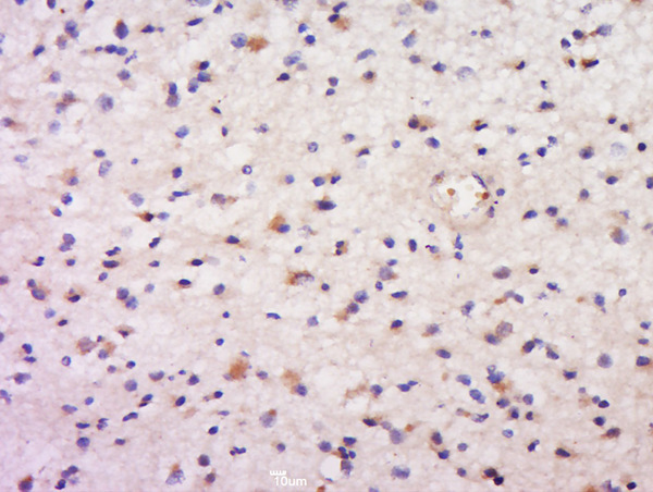 Formalin-fixed and paraffin embedded human brain glimoa labeled with Anti-DAND5 Polyclonal Antibody, Unconjugated (bs-14193R) at 1:500 followed by conjugation to the secondary antibody and DAB staining.