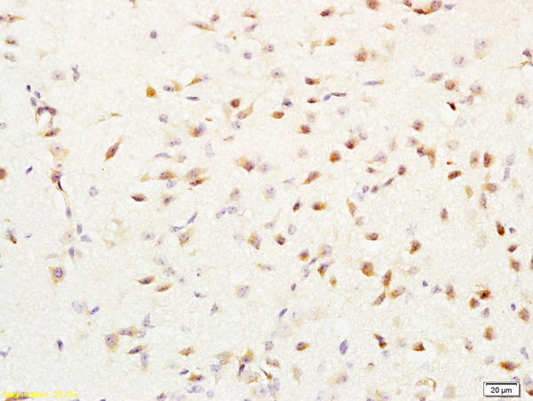Formalin-fixed and paraffin embedded human lung cancer labeled with Rabbit Anti-MGMT Polyclonal Antibody, Unconjugated (bs-1002R) at 1:200 followed by conjugation to the secondary antibody and DAB staining