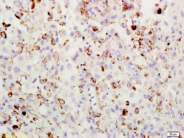 Formalin-fixed and paraffin embedded mouse melanoma labeled with Rabbit Anti ABCB5 Polyclonal Antibody, Unconjugated (bs-1604R) at 1:200 followed by conjugation to the secondary antibody and DAB staining