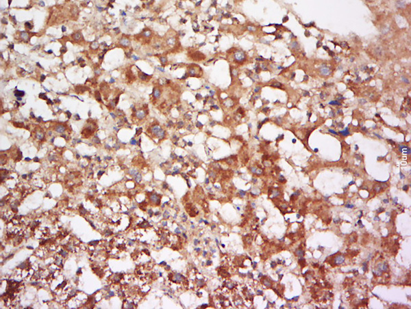 Formalin-fixed and paraffin embedded human liver carcinoma labeled with Anti-FUCA2 Polyclonal Antibody, Unconjugated (bs-16192R) at 1:500 followed by conjugation to the secondary antibody and DAB staining