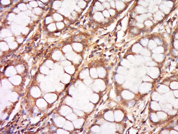 Formalin-fixed and paraffin embedded human cervix carcinoma labeled with Anti-DNCLI1 Polyclonal Antibody, Unconjugated (bs-20152R) at 1:500 followed by conjugation to the secondary antibody and DAB staining.