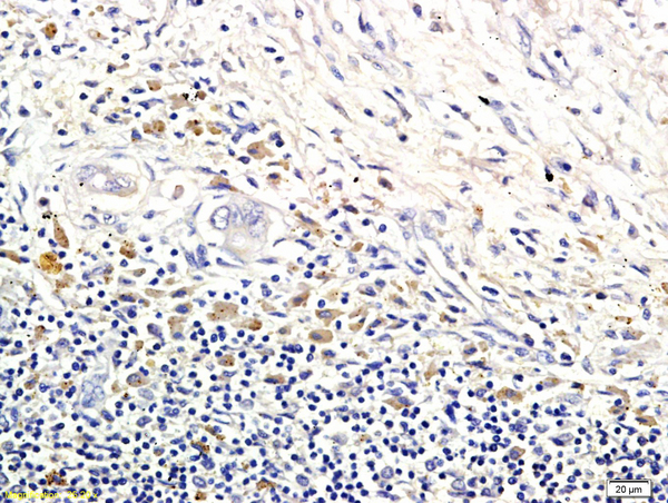 Formalin-fixed and paraffin embedded human colorectal cancer labeled with Anti-LI-cadherin Polyclonal Antibody, Unconjugated (bs-1617R) followed by conjugation to the secondary antibody and DAB staining\n