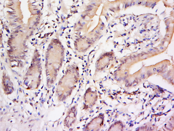 Formalin-fixed and paraffin embedded human colon carcinoma labeled with Anti-STAT3 (Tyr705) Polyclonal Antibody, Unconjugated (bs-1658R) at 1:200 followed by conjugation to the secondary antibody and DAB staining.