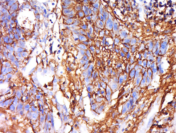 Formalin-fixed and paraffin embedded human lung carcinoma labeled with Anti-IRGQ Polyclonal Antibody, Unconjugated (bs-16707R) at 1:500 followed by conjugation to the secondary antibody and DAB staining.