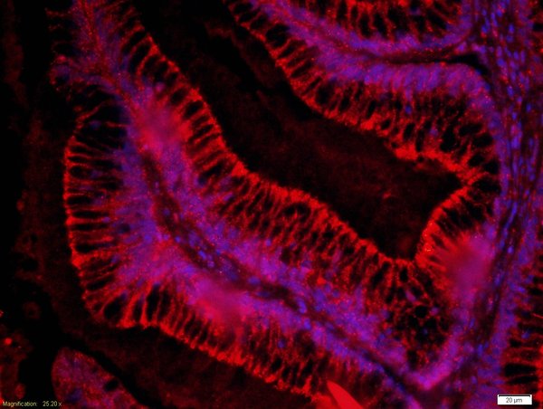 Paraformaldehyde-fixed, paraffin embedded human colon cancer; Antigen retrieval by boiling in sodium citrate buffer (pH6) for 15min; Block endogenous peroxidase by 3% hydrogen peroxide for 30 minutes; Blocking buffer (normal goat serum) at 37°C for 20min; Antibody incubation with \tRabbit Anti-FZD3/Frizzled 3 Polyclonal Antibody, Unconjugated ( \tbs-13239R ) at 1:200 overnight at 4°C, followed by the secondary antibody was Goat Anti-Rabbit IgG, Cy3 conjugated(bs-0295G-Cy)and used at 1:200 dilution for 40 minutes at 37°CDAPI(5ug/ml) was used to stain the cell nuclei