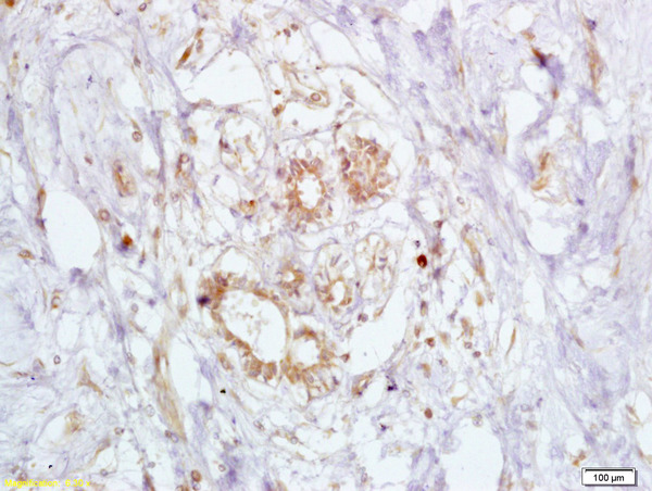 Formalin-fixed and paraffin embedded human breast carcinoma labeled Anti-BRCA2 Polyclonal Antibody, Unconjugated (bs-1210R) at 1:200, followed by conjugation to the secondary antibody and DAB staining