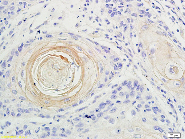 Formalin-fixed and paraffin embedded human oral squamous cell carcinoma labeled with Anti-IL-17 Polyclonal Antibody, Unconjugated(bs-2140R) at 1:200 followed by conjugation to the secondary antibody and DAB staining