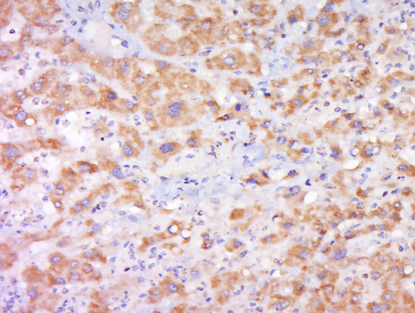 Paraformaldehyde-fixed, paraffin embedded human liver cancer; Antigen retrieval by boiling in sodium citrate buffer (pH6) for 15min; Block endogenous peroxidase by 3% hydrogen peroxide for 30 minutes; Blocking buffer (normal goat serum) at 37°C for 20min; Antibody incubation with Rabbit Anti-Cytochrome b245 Light Chain Polyclonal Antibody, Unconjugated (bs-3879R) at 1:500 overnight at 4°C, followed by a conjugated secondary and DAB staining.