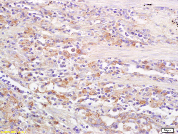 Formalin-fixed and paraffin embedded human lung carcinoma labeled with  Rabbit Anti CD69\/CLEC2C\/AIM Polyclonal Antibody, Unconjugated (bs-2499R) at 1:200 followed by conjugation to the secondary antibody and DAB staining