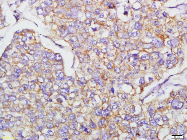 Paraformaldehyde-fixed, paraffin embedded human lung carcinoma tissue; Antigen retrieval by boiling in sodium citrate buffer(pH6) for 15min; Block endogenous peroxidase by 3% hydrogen peroxide for 30 minutes; Blocking buffer (normal goat serum) at 37°C for 20min; Antibody incubation with Rabbit Anti-N-cadherin Polyclonal Antibody, Unconjugated (bs-1172R) at 1:400 overnight at 4°C, followed by a conjugated secondary and DAB staining