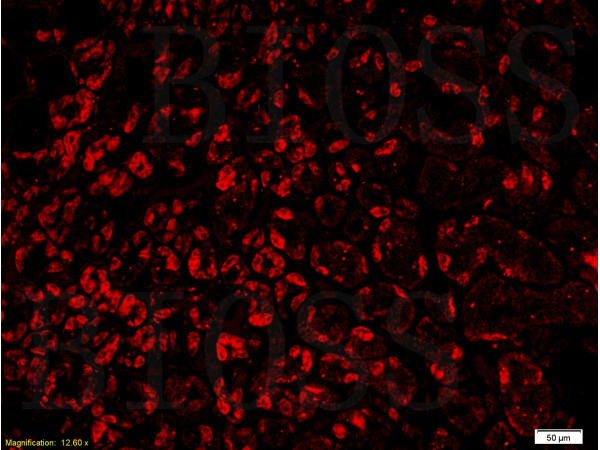 Formalin-fixed and paraffin embedded human gastric adenocarcinoma labeled with Rabbit Anti-GPR30 Polyclonal Antibody (bs-1380R) at 1:300 followed by conjugation to the secondary antibody and DAB staining.