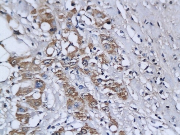 Formalin-fixed and paraffin embedded human breast cancer labeled with Anti-Ets1/ETS-1 Polyclonal Antibody, Unconjugated (bs-1285R) followed by conjugation to the secondary antibody and DAB staining