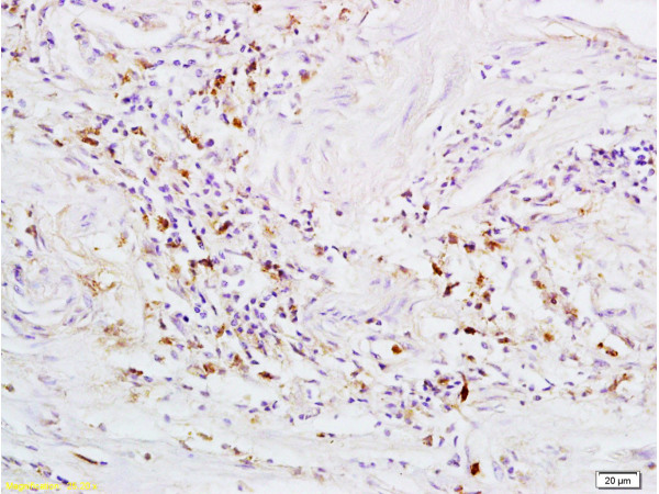 Formalin-fixed and paraffin embedded human rectal carcinoma tissue labeled with Rabbit Anti-GPR30 Polyclonal Antibody (bs-1380R) at 1:200 followed by conjugation to the secondary antibody and DAB staining.