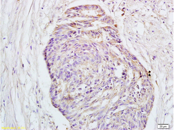 Formalin-fixed and paraffin embedded human rectal carcinoma tissue labeled with Rabbit Anti-GPR30 Polyclonal Antibody (bs-1380R) at 1:200 followed by conjugation to the secondary antibody and DAB staining.