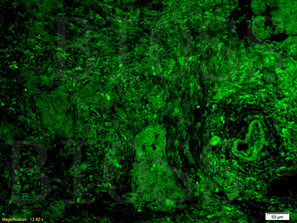 Formalin-fixed and paraffin embedded human rectal carcinoma tissue labeled with Rabbit Anti-GPR30 Polyclonal Antibody (bs-1380R) at 1:200 followed by conjugation to the secondary antibody and DAB staining