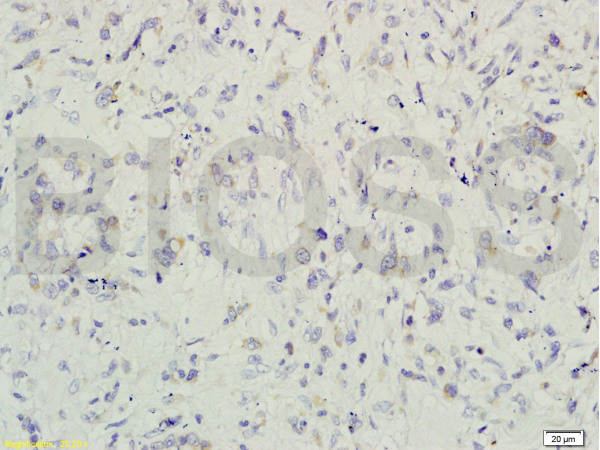 Formalin-fixed and paraffin embedded human colon carcinoma labeled with Rabbit Anti-gremlin Polyclonal Antibody (bs-1475R) at 1:200 followed by conjugation to the secondary antibody and DAB staining.