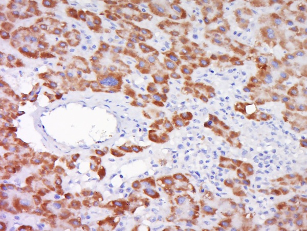 Paraformaldehyde-fixed, paraffin embedded human liver cancer; Antigen retrieval by boiling in sodium citrate buffer (pH6) for 15min; Block endogenous peroxidase by 3% hydrogen peroxide for 30 minutes; Blocking buffer (normal goat serum) at 37°C for 20min; Antibody incubation with SOD1 Polyclonal antibody, Unconjugated (bs-10216R) at 1:500 overnight at 4°C, followed by a conjugated secondary and DAB staining