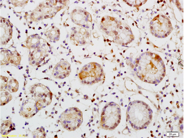 Formalin-fixed and paraffin embedded human colon carcinoma tissue labeled with Rabbit Anti-TEM1/CD248 Polyclonal Antibody (bs-2101R) at 1:200 followed by conjugation to the secondary antibody and DAB staining. Formalin-fixed and paraffin embedded human colon carcinoma tissue labeled with Rabbit Anti-TEM1/CD248 Polyclonal Antibody (bs-2101R) at 1:200 followed by conjugation to the secondary antibody and DAB staining.