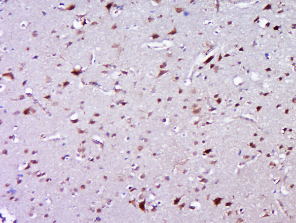 Formalin-fixed and paraffin embedded human glioma labeled with ZNF502 Polyclonal Antibody, Unconjugated (bs-19536R) at 1:200 followed by conjugation to the secondary antibody and DAB staining