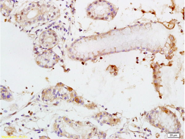 Formalin-fixed and paraffin embedded human colon carcinoma tissue labeled with Rabbit Anti-TEM1/CD248 Polyclonal Antibody (bs-2101R) at 1:200 followed by conjugation to the secondary antibody and DAB staining.