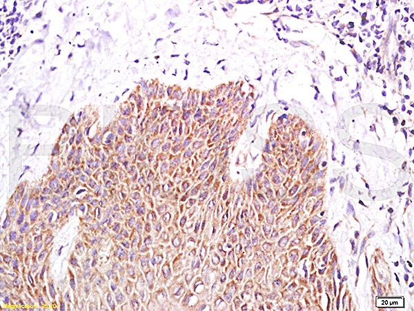 Formalin-fixed and paraffin-embedded human skin psoriasis labeled with Rabbit Anti- PPARr gamma Polyclonal Antibody, Unconjugated (bs-0530R) at 1:200 followed by conjugation to the secondary antibody and DAB staining
