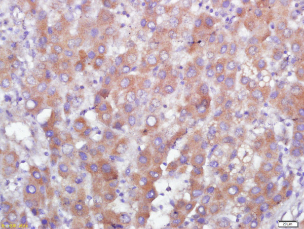 Paraformaldehyde-fixed, paraffin embedded human liver carcinoma tissue; Antigen retrieval by boiling in sodium citrate buffer(pH6) for 15min; Block endogenous peroxidase by 3% hydrogen peroxide for 30 minutes; Blocking buffer (normal goat serum) at 37°C for 20min; Antibody incubation with GPR110 Polyclonal Antibody, Unconjugated (bs-13513R) at 1:500 overnight at 4°C, followed by a conjugated secondary and DAB staining