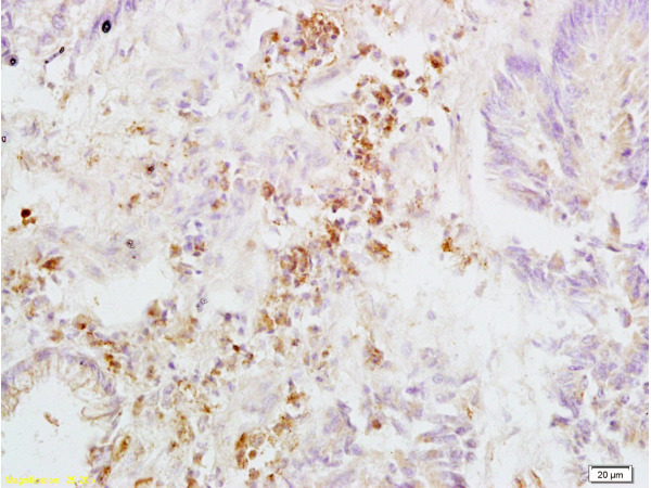 Formalin-fixed and paraffin embedded human rectal carcinoma labeled with Anti-Integrin beta 3\/CD61 Polyclonal Antibody, Unconjugated (bs-0342R) at 1:200, followed by conjugation to the secondary antibody and DAB staining