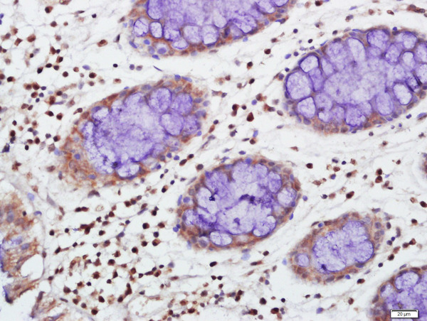 Paraformaldehyde-fixed, paraffin embedded human colon carcinoma tissue; Antigen retrieval by boiling in sodium citrate buffer(pH6) for 15min; Block endogenous peroxidase by 3% hydrogen peroxide for 30 minutes; Blocking buffer (normal goat serum) at 37°C for 20min; Antibody incubation with TIA1 Polyclonal Antibody, Unconjugated (bs-7105R) at 1:500 overnight at 4°C, followed by a conjugated secondary and DAB staining