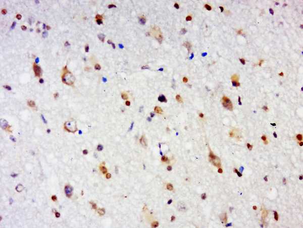 Paraformaldehyde-fixed, paraffin embedded human glioma tissue; Antigen retrieval by boiling in sodium citrate buffer(pH6) for 15min; Block endogenous peroxidase by 3% hydrogen peroxide for 30 minutes; Blocking buffer (normal goat serum) at 37°C for 20min; Antibody incubation with GPCR EX33 Polyclonal Antibody, Unconjugated (bs-15353R) at 1:500 overnight at 4°C, followed by a conjugated secondary and DAB staining