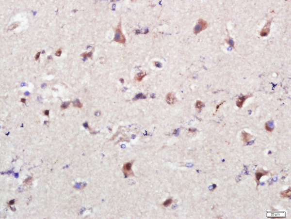 Formalin-fixed and paraffin embedded human brain glioma labeled with PSMG1 Polyclonal Antibody, Unconjugated (bs-19577R) at 1:200 followed by conjugation to the secondary antibody and DAB staining