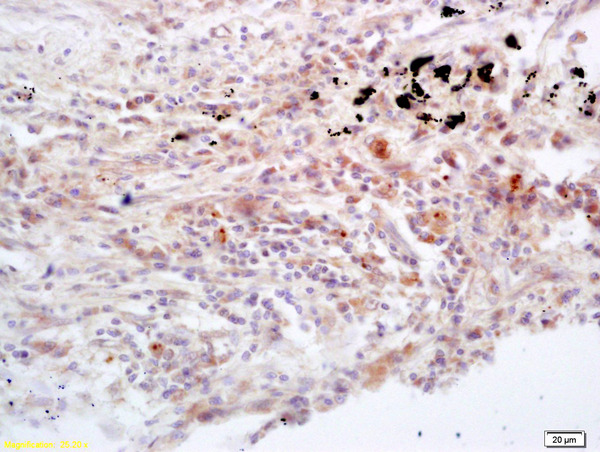Formalin-fixed and paraffin embedded human lung carcinoma labeled with Rabbit Anti Jak3 Polyclonal Antibody, Unconjugated (bs-2808R) at 1:200 followed by conjugation to the secondary antibody and DAB staining