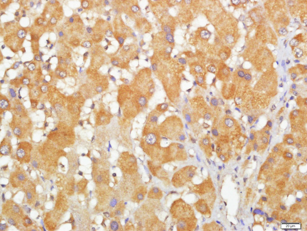Paraformaldehyde-fixed, paraffin embedded human liver cancer; Antigen retrieval by boiling in sodium citrate buffer (pH6) for 15min; Block endogenous peroxidase by 3% hydrogen peroxide for 30 minutes; Blocking buffer (normal goat serum) at 37°C for 20min; Antibody incubation with CCDC69 Polyclonal Antibody, Unconjugated (bs-6919R) at 1:200 overnight at 4°C, followed by a conjugated secondary and DAB staining