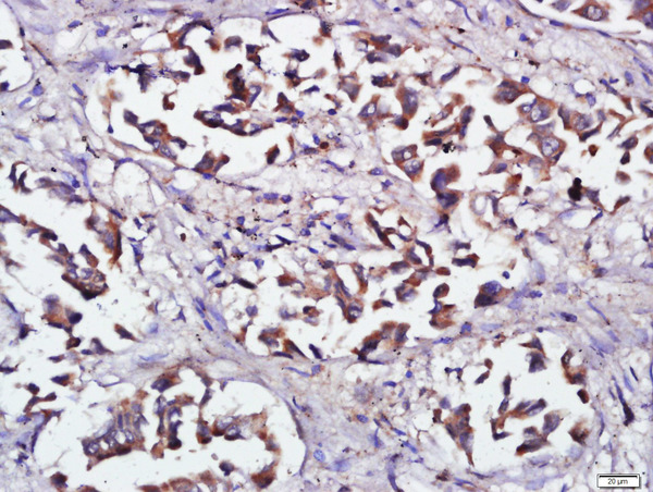 Paraformaldehyde-fixed, paraffin embedded human lung cancer; Antigen retrieval by boiling in sodium citrate buffer (pH6) for 15min; Block endogenous peroxidase by 3% hydrogen peroxide for 30 minutes; Blocking buffer (normal goat serum) at 37°C for 20min; Antibody incubation with RNF138 Polyclonal Antibody, Unconjugated (bs-9254R) at 1:500 overnight at 4°C, followed by a conjugated secondary and DAB staining.