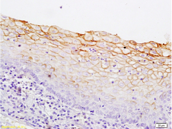 Formalin-fixed and paraffin embedded human breast carcinoma labeled with Rabbit Anti Cytokeratin 5/CK5 Polyclonal Antibody, Unconjugated (bs-1060R) at 1:200 followed by conjugation to the secondary antibody and DAB staining