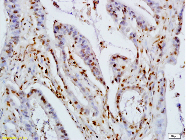 Formalin-fixed and paraffin embedded human colon carcinoma labeled with Rabbit Anti KLF4 Polyclonal Antibody, Unconjugated (bs-1064R) at 1:200 followed by conjugation to the secondary antibody and DAB staining