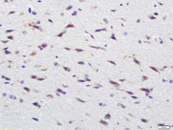Paraformaldehyde-fixed, paraffin embedded EGFR5 Polyclonal Antibody; Antigen retrieval by boiling in sodium citrate buffer (pH6) for 15min; Block endogenous peroxidase by 3% hydrogen peroxide for 30 minutes; Blocking buffer (normal goat serum) at 37°C for 20min; Antibody incubation with EGFR5 Polyclonal Antibody, Unconjugated (bs-9813R) at 1:500 overnight at 4°C, followed by a conjugated secondary and DAB staining.