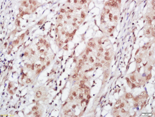 Paraformaldehyde-fixed, paraffin embedded human esophageal cancer; Antigen retrieval by boiling in sodium citrate buffer (pH6) for 15min; Block endogenous peroxidase by 3% hydrogen peroxide for 30 minutes; Blocking buffer (normal goat serum) at 37°C for 20min; Antibody incubation with FOG1 Polyclonal Antibody, Unconjugated (bs-9451R) at 1:400 overnight at 4°C, followed by a conjugated secondary and DAB staining.