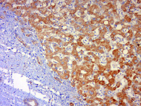 Paraformaldehyde-fixed, paraffin embedded human lung carcinoma; Antigen retrieval by boiling in sodium citrate buffer (pH6) for 15min; Block endogenous peroxidase by 3% hydrogen peroxide for 30 minutes; Blocking buffer (normal goat serum) at 37°C for 20min; Antibody incubation with \tJNK1 + 3 Polyclonal Antibody, Unconjugated (bs-0501R) at 1:500 overnight at 4°C, followed by a conjugated secondary and DAB staining.