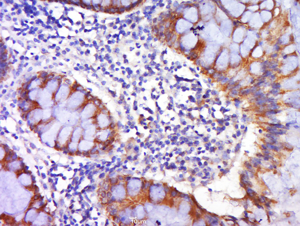 Paraformaldehyde-fixed, paraffin embedded human colon carcinoma tissue; Antigen retrieval by boiling in sodium citrate buffer(pH6) for 15min; Block endogenous peroxidase by 3% hydrogen peroxide for 30 minutes; Blocking buffer (normal goat serum) at 37°C for 20min; Antibody incubation with Rabbit Anti-DR4 Polyclonal Antibody, Unconjugated (bs-0591R) at 1:500 overnight at 4°C, followed by a conjugated secondary and DAB staining