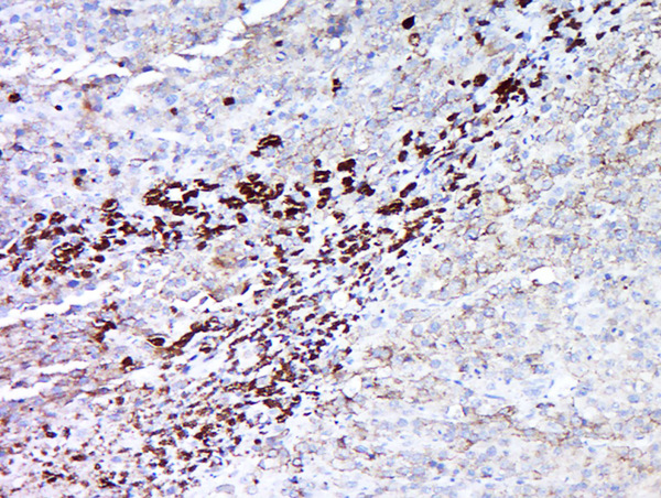 Paraformaldehyde-fixed, paraffin embedded human melanoma tissue; Antigen retrieval by boiling in sodium citrate buffer(pH6) for 15min; Block endogenous peroxidase by 3% hydrogen peroxide for 30 minutes; Blocking buffer (normal goat serum) at 37°C for 20min; Antibody incubation with Rabbit Anti-MAGEA5 Polyclonal Antibody, Unconjugated (bs-6820R) at 1:500 overnight at 4°C, followed by a conjugated secondary and DAB staining