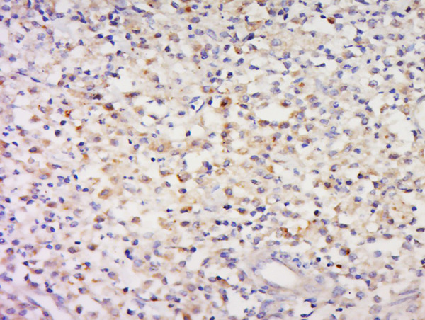 Paraformaldehyde-fixed, paraffin embedded human cervical carcinoma tissue; Antigen retrieval by boiling in sodium citrate buffer(pH6) for 15min; Block endogenous peroxidase by 3% hydrogen peroxide for 30 minutes; Blocking buffer (normal goat serum) at 37°C for 20min; Antibody incubation with Rabbit Anti-CCDC58 Polyclonal Antibody, Unconjugated (bs-8080R) at 1:500 overnight at 4°C, followed by a conjugated secondary and DAB staining
