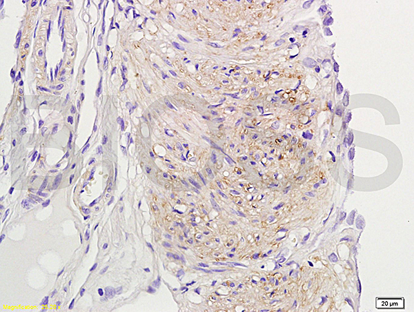 Formalin-fixed and paraffin embedded rat uterine myoma labeled with  Rabbit Anti-ER-beta Polyclonal Antibody (bs-0166R) at 1:200 followed by conjugation to the secondary antibody and DAB staining.