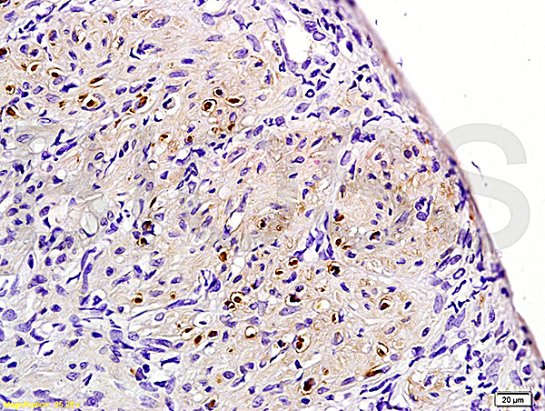 Formalin-fixed and paraffin embedded rat uterine myoma labeled with Rabbit Anti-ER-beta Polyclonal Antibody (bs-0166R)  at 1:200 followed by conjugation to the secondary antibody and DAB staining.