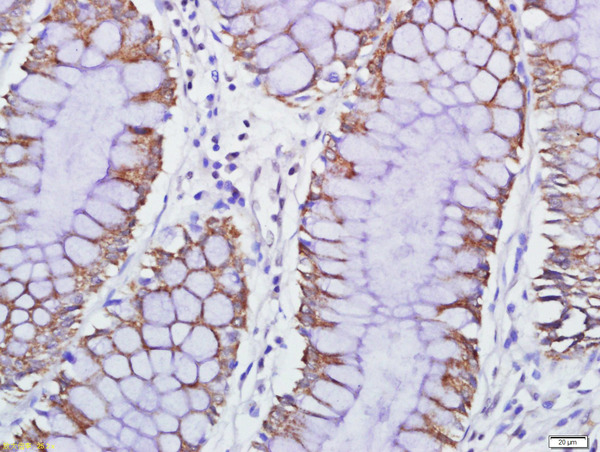 Paraformaldehyde-fixed, paraffin embedded human colon carcinoma; Antigen retrieval by boiling in sodium citrate buffer (pH6) for 15min; Block endogenous peroxidase by 3% hydrogen peroxide for 30 minutes; Blocking buffer (normal goat serum) at 37°C for 20min; Antibody incubation with GPCR EX33 Polyclonal Antibody, Unconjugated (bs-15353R) at 1:500 overnight at 4°C, followed by a conjugated secondary and DAB staining.
