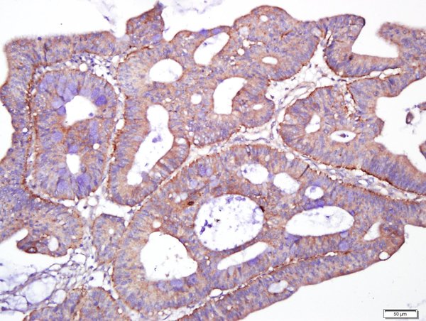 Paraformaldehyde-fixed, paraffin embedded human cervix cancer; Antigen retrieval by boiling in sodium citrate buffer (pH6.0) for 15min; Block endogenous peroxidase by 3% hydrogen peroxide for 20 minutes; Blocking buffer (normal goat serum) at 37°C for 30min; Antibody incubation with\tGiantin/GOLGB1 Polyclonal Antibody Polyclonal Antibody, Unconjugated (bs-13356R) at 1:400 overnight at 4°C, followed by a conjugated secondary for 20 minutes and DAB staining.