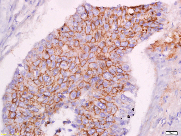 Paraformaldehyde-fixed, paraffin embedded human lung carcinoma; Antigen retrieval by boiling in sodium citrate buffer (pH6.0) for 15min; Block endogenous peroxidase by 3% hydrogen peroxide for 20 minutes; Blocking buffer (normal goat serum) at 37°C for 30min; Antibody incubation with CLEC16A Polyclonal Antibody, Unconjugated (bs-18539R) at 1:400 overnight at 4°C, followed by a conjugated secondary for 20 minutes and DAB staining.