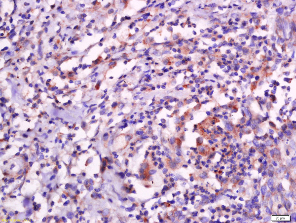 Paraformaldehyde-fixed, paraffin embedded human esophageal carcinoma; Antigen retrieval by boiling in sodium citrate buffer (pH6.0) for 15min; Block endogenous peroxidase by 3% hydrogen peroxide for 20 minutes; Blocking buffer (normal goat serum) at 37°C for 30min; Antibody incubation with Sarcalumenin Polyclonal Antibody, Unconjugated (bs-19394R) at 1:400 overnight at 4°C, followed by a conjugated secondary for 20 minutes and DAB staining.