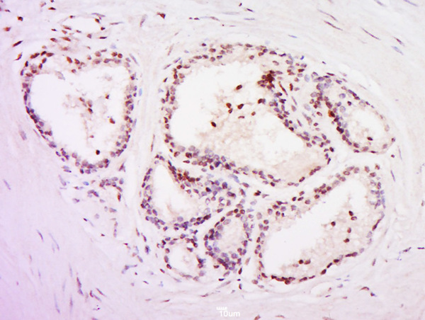 Paraformaldehyde-fixed, paraffin embedded human prostate tissue; Antigen retrieval by boiling in sodium citrate buffer (pH6.0) for 15min; Block endogenous peroxidase by 3% hydrogen peroxide for 20 minutes; Blocking buffer (normal goat serum) at 37°C for 30min; Antibody incubation with POLR3C Polyclonal Antibody, Unconjugated (bs-9569R) at 1:400 overnight at 4°C, followed by a conjugated secondary for 20 minutes and DAB staining.