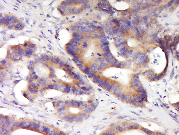 Paraformaldehyde-fixed, paraffin embedded human colon carcinoma; Antigen retrieval by boiling in sodium citrate buffer (pH6.0) for 15min; Block endogenous peroxidase by 3% hydrogen peroxide for 20 minutes; Blocking buffer (normal goat serum) at 37°C for 30min; Antibody incubation with KCNV2 Polyclonal Antibody, Unconjugated (bs-16921R) at 1:400 overnight at 4°C, followed by a conjugated secondary for 20 minutes and DAB staining.