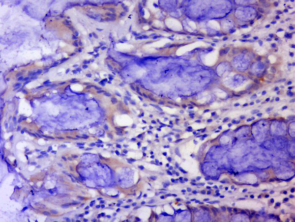 Paraformaldehyde-fixed, paraffin embedded human colon carcinoma tissue; Antigen retrieval by boiling in sodium citrate buffer(pH6) for 15min; Block endogenous peroxidase by 3% hydrogen peroxide for 30 minutes; Blocking buffer (normal goat serum) at 37°C for 20min; Antibody incubation with Rabbit Anti-CWG43 Polyclonal Antibody, Unconjugated (bs-9959R) at 1:400 overnight at 4°C, followed by a conjugated secondary and DAB staining